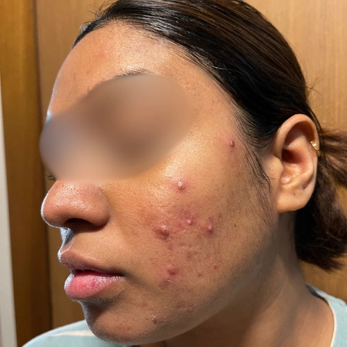 Acne is not just a surface problem — understanding root causes