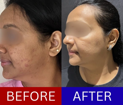 Cystic acne before and after treatment — The Pimple Post Clinic