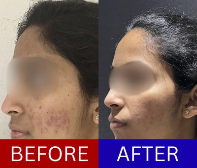 Acne scar correction before and after — staged protocol