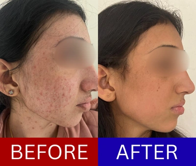 Hormonal adult acne before and after treatment