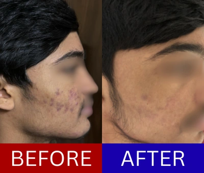 Post-acne marks and texture improvement