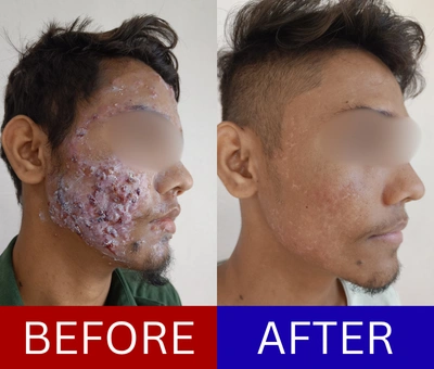 Texture and post-acne marks before and after — combined protocol with diagnosis-driven sequencing